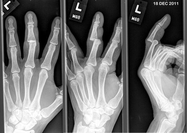 A kimozdult ujjak röntgenfelvétele
