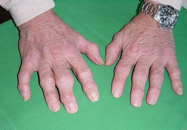 Az ujjak osteoarthritisje