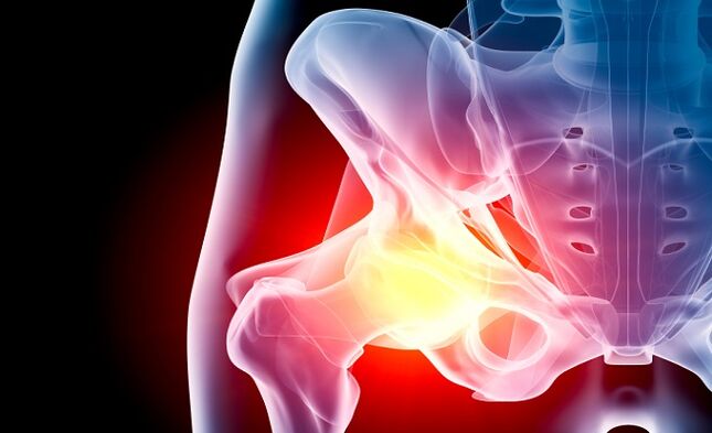 a csípőízület arthrosisa
