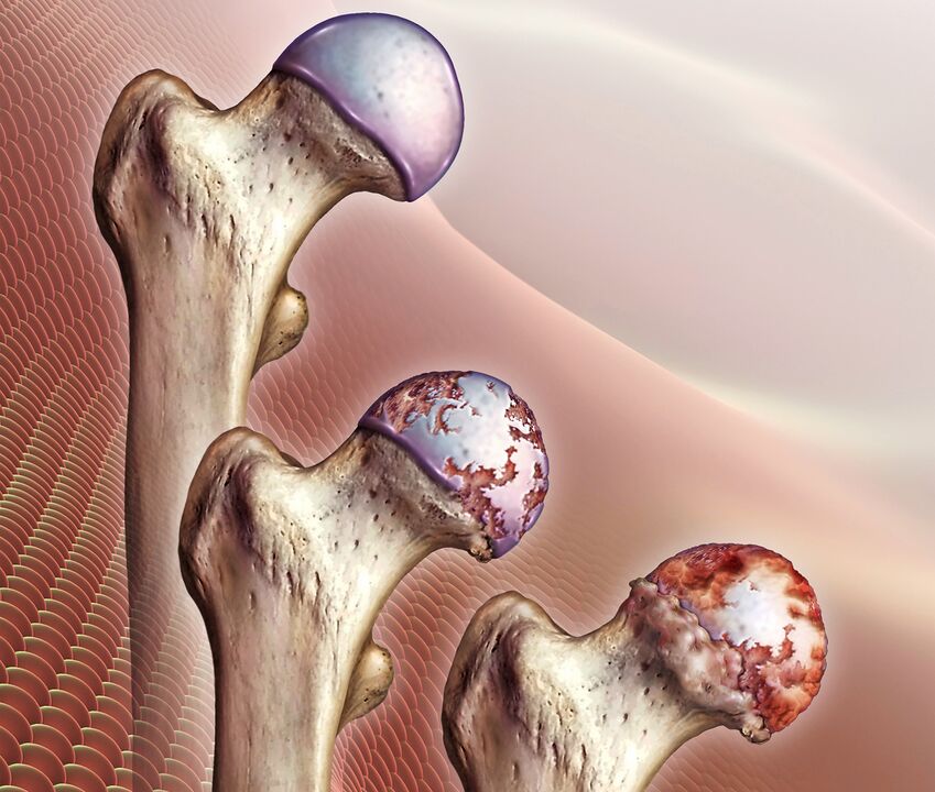 A csípőízület arthrosisának kialakulása