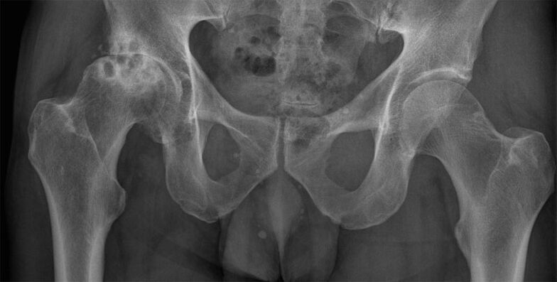 A csípőízület deformáló arthrosisa röntgenfelvételen