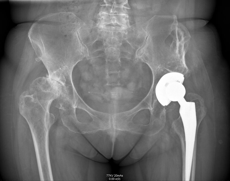 A csípőízület röntgenfelvétele artroplasztika után
