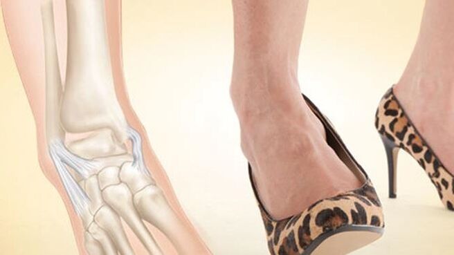 sarkú cipő viselése a boka arthrosisának okaként