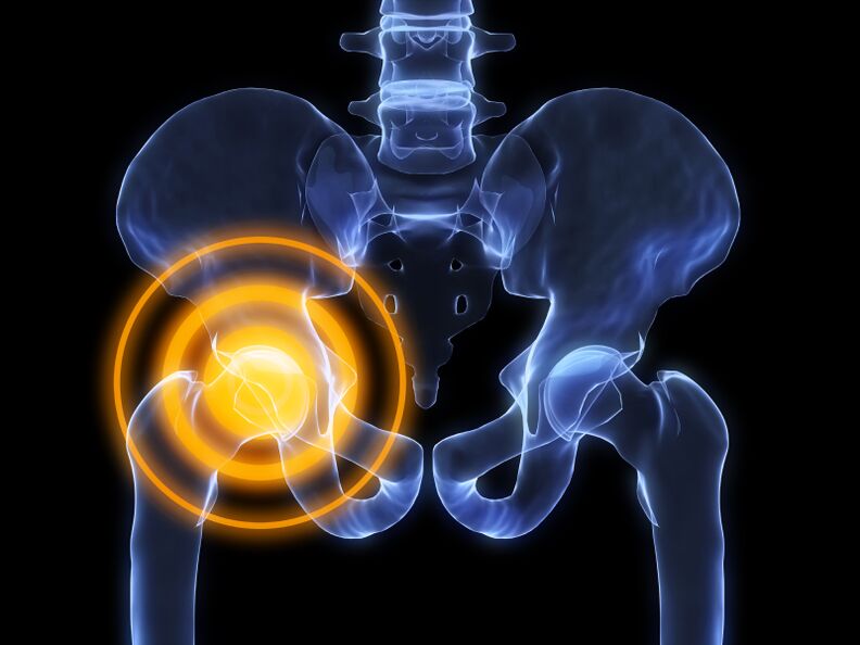 a csípőízület arthrosisa